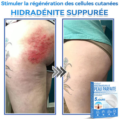 𝐆𝐚𝐟𝐚𝐜𝐞® 𝐌𝐢𝐜𝐫𝐚𝐢𝐠𝐮𝐢𝐥𝐥𝐞 𝐏𝐞𝐚𝐮 𝐏𝐚𝐫𝐟𝐚𝐢𝐭𝐞 𝐏𝐚𝐭𝐜𝐡 𝐃𝐞 𝐑𝐞𝐭𝐫𝐚𝐢𝐭 𝐃'𝐚𝐜𝐫𝐨𝐜𝐡𝐨𝐫𝐝𝐨𝐧𝐬🚀🚀 | Traitement pour grains de beauté en relief, acné, verrues planes et acrochordons
