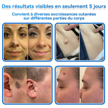 𝐆𝐚𝐟𝐚𝐜𝐞® 𝐌𝐢𝐜𝐫𝐚𝐢𝐠𝐮𝐢𝐥𝐥𝐞 𝐏𝐞𝐚𝐮 𝐏𝐚𝐫𝐟𝐚𝐢𝐭𝐞 𝐏𝐚𝐭𝐜𝐡 𝐃𝐞 𝐑𝐞𝐭𝐫𝐚𝐢𝐭 𝐃'𝐚𝐜𝐫𝐨𝐜𝐡𝐨𝐫𝐝𝐨𝐧𝐬🚀🚀 | Traitement pour grains de beauté en relief, acné, verrues planes et acrochordons
