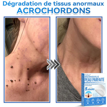 𝐆𝐚𝐟𝐚𝐜𝐞® 𝐌𝐢𝐜𝐫𝐚𝐢𝐠𝐮𝐢𝐥𝐥𝐞 𝐏𝐞𝐚𝐮 𝐏𝐚𝐫𝐟𝐚𝐢𝐭𝐞 𝐏𝐚𝐭𝐜𝐡 𝐃𝐞 𝐑𝐞𝐭𝐫𝐚𝐢𝐭 𝐃'𝐚𝐜𝐫𝐨𝐜𝐡𝐨𝐫𝐝𝐨𝐧𝐬🚀🚀 | Traitement pour grains de beauté en relief, acné, verrues planes et acrochordons