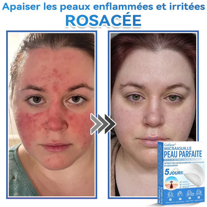 𝐆𝐚𝐟𝐚𝐜𝐞® 𝐌𝐢𝐜𝐫𝐚𝐢𝐠𝐮𝐢𝐥𝐥𝐞 𝐏𝐞𝐚𝐮 𝐏𝐚𝐫𝐟𝐚𝐢𝐭𝐞 𝐏𝐚𝐭𝐜𝐡 𝐃𝐞 𝐑𝐞𝐭𝐫𝐚𝐢𝐭 𝐃'𝐚𝐜𝐫𝐨𝐜𝐡𝐨𝐫𝐝𝐨𝐧𝐬🚀🚀 | Traitement pour grains de beauté en relief, acné, verrues planes et acrochordons