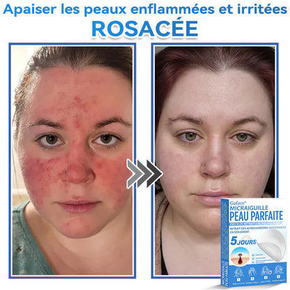 𝐆𝐚𝐟𝐚𝐜𝐞® 𝐌𝐢𝐜𝐫𝐚𝐢𝐠𝐮𝐢𝐥𝐥𝐞 𝐏𝐞𝐚𝐮 𝐏𝐚𝐫𝐟𝐚𝐢𝐭𝐞 𝐏𝐚𝐭𝐜𝐡 𝐃𝐞 𝐑𝐞𝐭𝐫𝐚𝐢𝐭 𝐃'𝐚𝐜𝐫𝐨𝐜𝐡𝐨𝐫𝐝𝐨𝐧𝐬🚀🚀 | Traitement pour grains de beauté en relief, acné, verrues planes et acrochordons