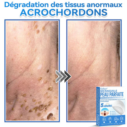 𝐆𝐚𝐟𝐚𝐜𝐞® 𝐌𝐢𝐜𝐫𝐚𝐢𝐠𝐮𝐢𝐥𝐥𝐞 𝐏𝐞𝐚𝐮 𝐏𝐚𝐫𝐟𝐚𝐢𝐭𝐞 𝐏𝐚𝐭𝐜𝐡 𝐃𝐞 𝐑𝐞𝐭𝐫𝐚𝐢𝐭 𝐃'𝐚𝐜𝐫𝐨𝐜𝐡𝐨𝐫𝐝𝐨𝐧𝐬🚀🚀 | Traitement pour grains de beauté en relief, acné, verrues planes et acrochordons