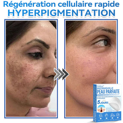 𝐆𝐚𝐟𝐚𝐜𝐞® 𝐌𝐢𝐜𝐫𝐚𝐢𝐠𝐮𝐢𝐥𝐥𝐞 𝐏𝐞𝐚𝐮 𝐏𝐚𝐫𝐟𝐚𝐢𝐭𝐞 𝐏𝐚𝐭𝐜𝐡 𝐃𝐞 𝐑𝐞𝐭𝐫𝐚𝐢𝐭 𝐃'𝐚𝐜𝐫𝐨𝐜𝐡𝐨𝐫𝐝𝐨𝐧𝐬🚀🚀 | Traitement pour grains de beauté en relief, acné, verrues planes et acrochordons